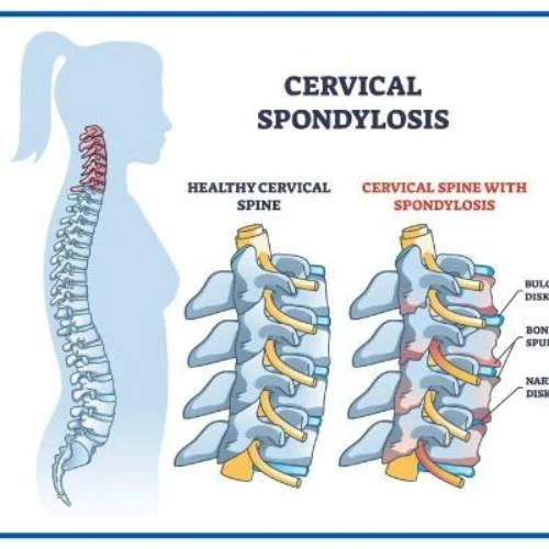 cervical-spondilysis