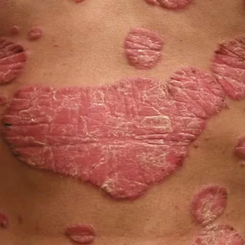 psoriasis