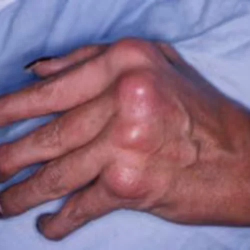 psoriatic-atritis