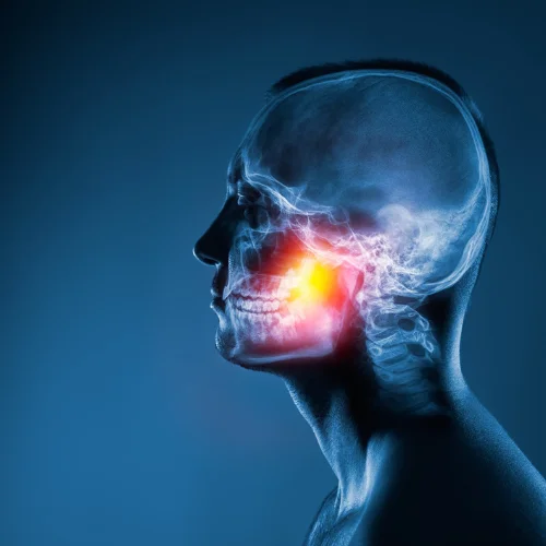 trigeminial-neurolgia