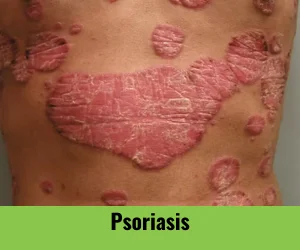 psoriasis