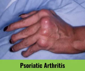 psoriatic-arthritis