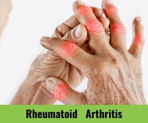 rheumatoid