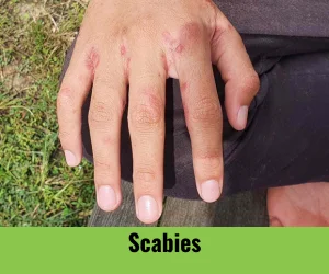 scabies