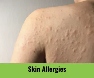 skin-allergies