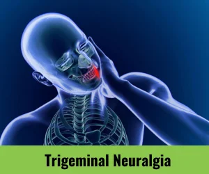 trigeminal-neuralgia