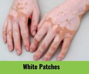 white-patches